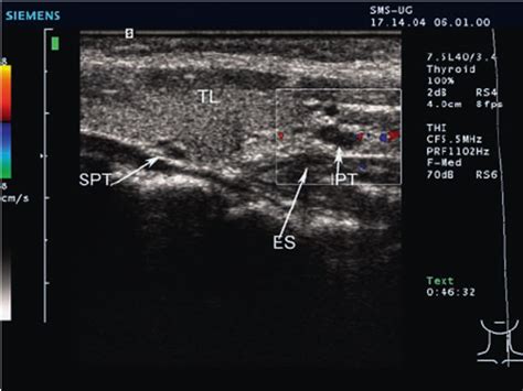 Normal Thyroid Gland Ultrasound