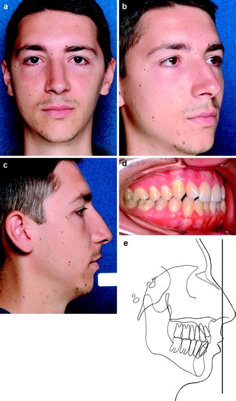 Dentofacial Deformities | Pocket Dentistry