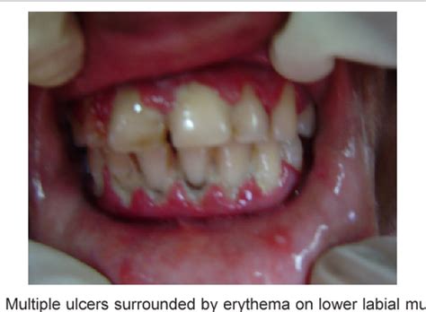 Acute Herpetic Gingivostomatitis Semantic Scholar