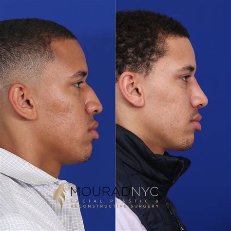 Rhinoplasty And Male Rhinoplasty And Ethnic Rhinoplasty Facial Plastic