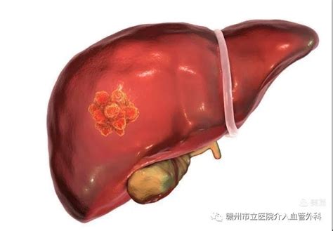 肝癌治疗“热技术”—— 微波消融“杀灭”恶性肿瘤 广东省人民医院赣州医院（赣州市立医院）