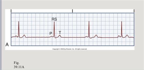 Ekg Strips Flashcards Quizlet