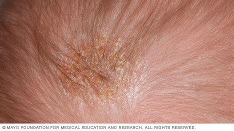 Slide show: Common baby rashes - Mayo Clinic