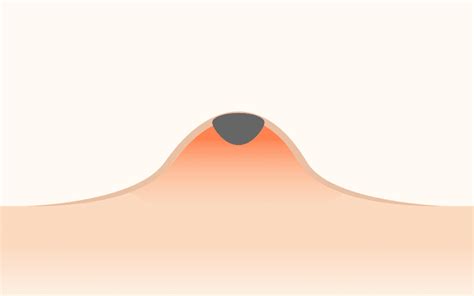 ニキビの原因・種類・治し方