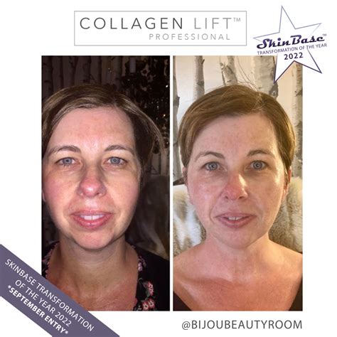 Cellulite Treatment Collagen Lift Before And After