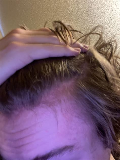 Is My Hairline Receding Maturing Or Something Else R Malehairadvice