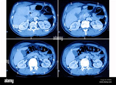 Computed tomography abdomen Banque de photographies et dimages à haute