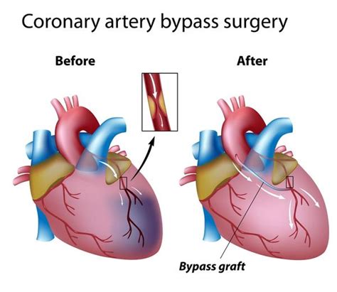 How Long Does It Take To Recover From Triple Bypass Heart Surgery