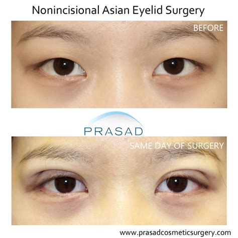 How Is A Double Eyelid Eyelid Crease Created Dr Prasad Blog