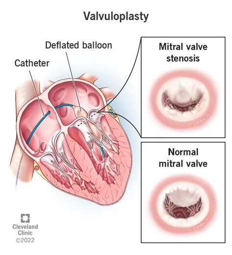 Percutaneous Mitral Valve Replacement