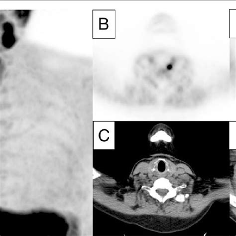 Example Of A Positive F Fluorocholine Pet Ct Representing A Double