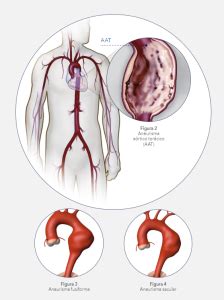 Qué es la aneurisma aórtico torácico Cuidando Tu Corazón