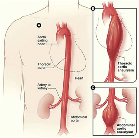 Aorta Anatomy Function Branches Location And Aorta Problems