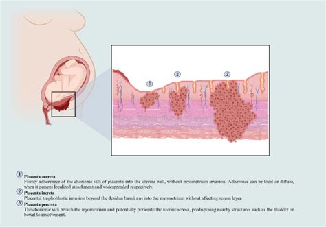 Figure The Placenta Accreta Spectrum Classification The Invasive Cells