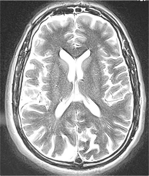 Brain MRI, frontal section. | Download Scientific Diagram