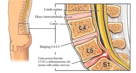 Discopatie E Ernie Lombari Rachide Lombare Fisio San Martino