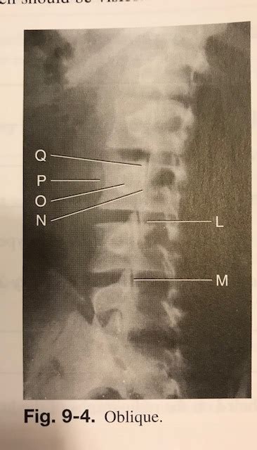 Oblique L Spine Diagram Quizlet