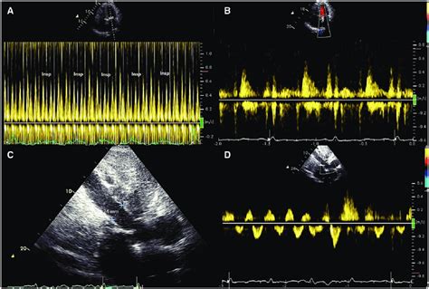 A Pulsed Doppler Recording Of Left Ventricular Inflow Showing Reduced Download Scientific