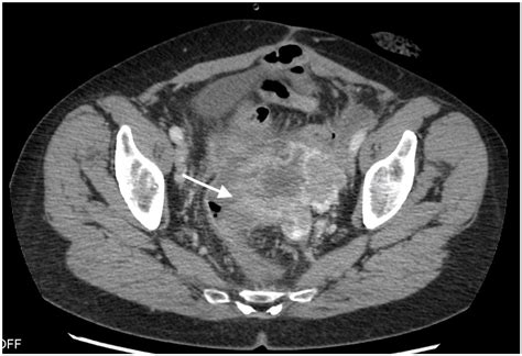 Tumor Bowel Fistula As A Rare Form Of Recurrent Ovarian Cancer—imaging