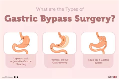 Gastric Bypass Surgery Procedure Recovery Cost Risk And Complication