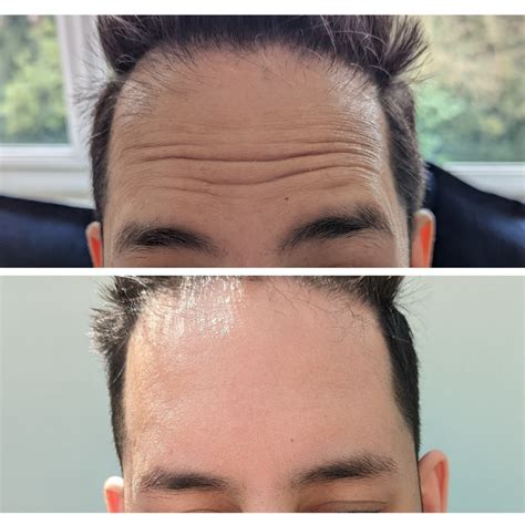 A Males Perspective Getting Botox For The First Time Unndoo Blog