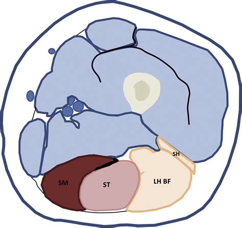 Ultrasound Assessment Of The Hamstrings Complex Of Athletes With Mri Correlation Clinical