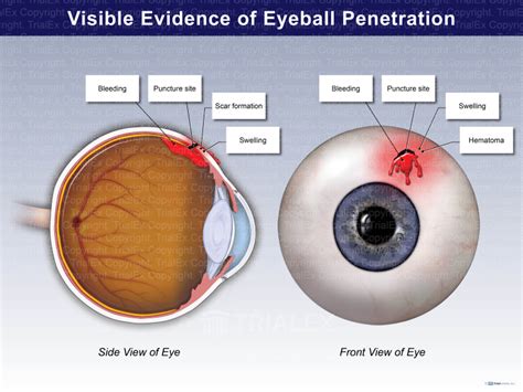 Visible Evidence Of Eyeball Penetration TrialQuest Inc