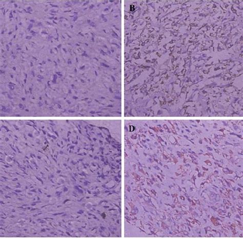 The Expression Of CXCR4 And VEGF Evaluated By TMA In Osteosarcoma