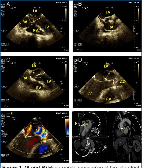 Figure From Extension Of A Mitral Aorta Intervalvular Fibrosa