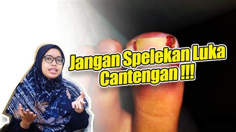 Penanganan Luka Infeksi Cantengan YouTube