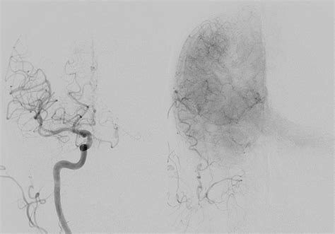 Vertebral Artery