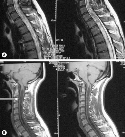 Thoracic Spine X Ray Labeled Cloudshareinfo Hot Sex Picture