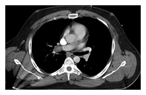 High Resolution Ct Scan Of Hilar Lymphadenopathy With Pulmonary Vein Download Scientific