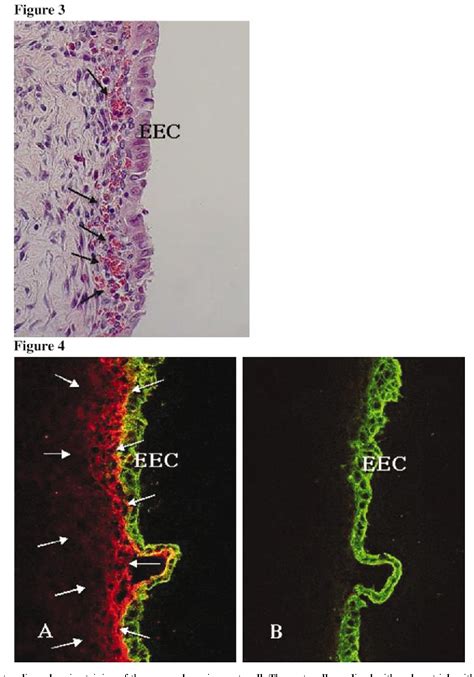 Figure 3 From Acute Elevation Of Plasma D Dimer Levels Associated With