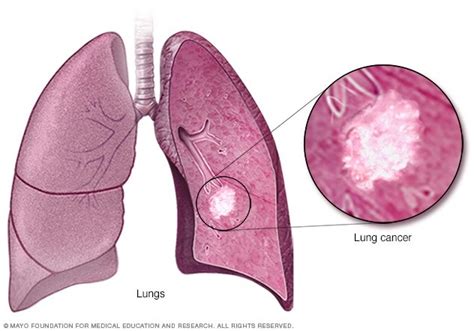 Lung Cancer Symptoms Treatment KHCC