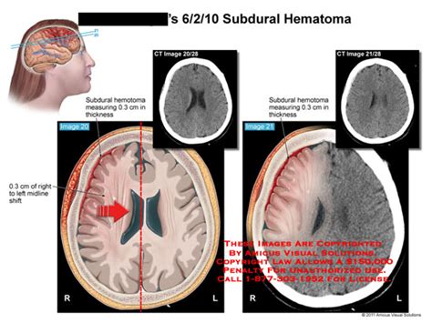 Amicus Illustration Of Amicus Injury Head Skull Subdural Hematoma Brain