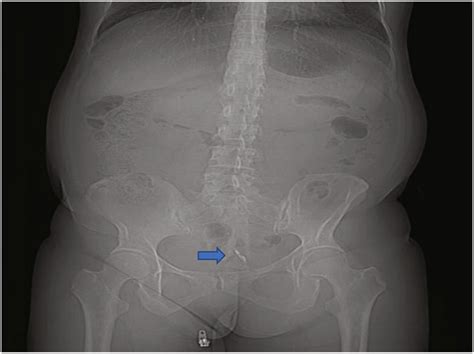 Plain Abdominal X Ray With Arrow Pointing Towards Iucd Download Scientific Diagram