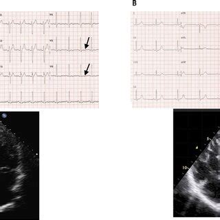 Twelve Lead Electrocardiogram In Two Cases Of Augmented Left