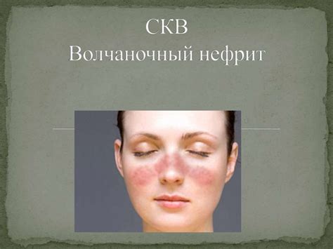 Волчаночный нефрит - online presentation