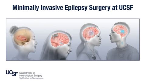 Surgery For Epilepsy Advanced Techniques And Appropriate Candidates Ucsf Medconnection