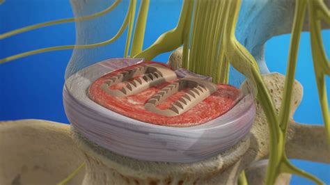 Posterior Lumbar Interbody Fusion Plif California Orthopaedic