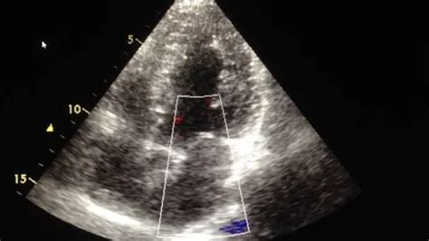 Echocardiography (ultrasound examination... | Stock Video | Pond5