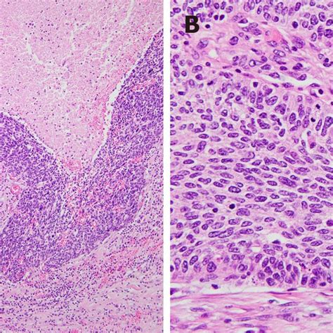 Pathological Findings Of The Tumor A At A Lower Power View The Tumor