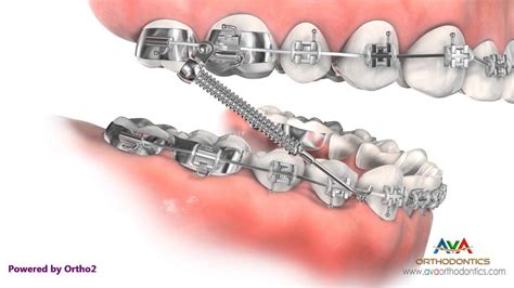 Overjet Aka Overbite Treatment By Forsus Orthodontic Device Youtube