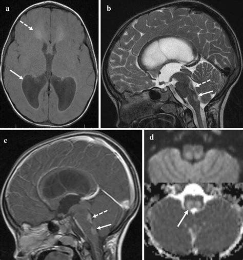 Alexander Disease Juvenile Form On This Axial Unenhanced T Weighted