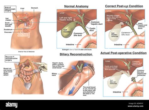 Gall Bladder Removal Fotografías E Imágenes De Alta Resolución Alamy