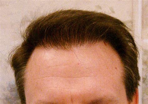 3500 Grafts La Jolla Hair Restoration