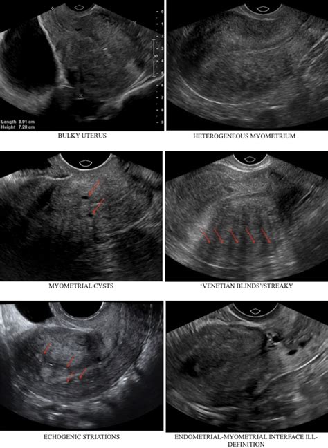 Six Commonly Described Sonographic Features In Uterine Adenomyosis