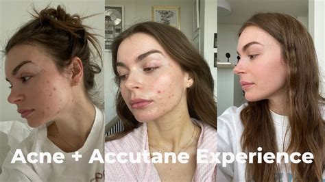 Acne Epuris Accutane Experience Journey Side Effects Youtube