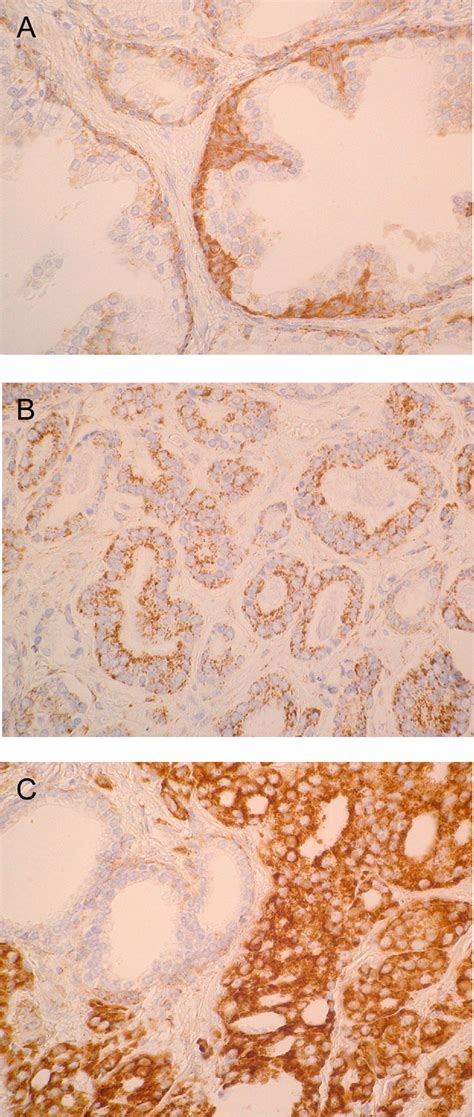 Immunohistochemical Expression Of Hsp60 Correlates With Tumor